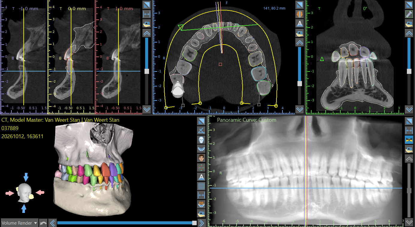 Planningssoftware met doorsneden van een CBCT, een panoramische opname en een driedimensionaal model met per tand een eigen kleur.